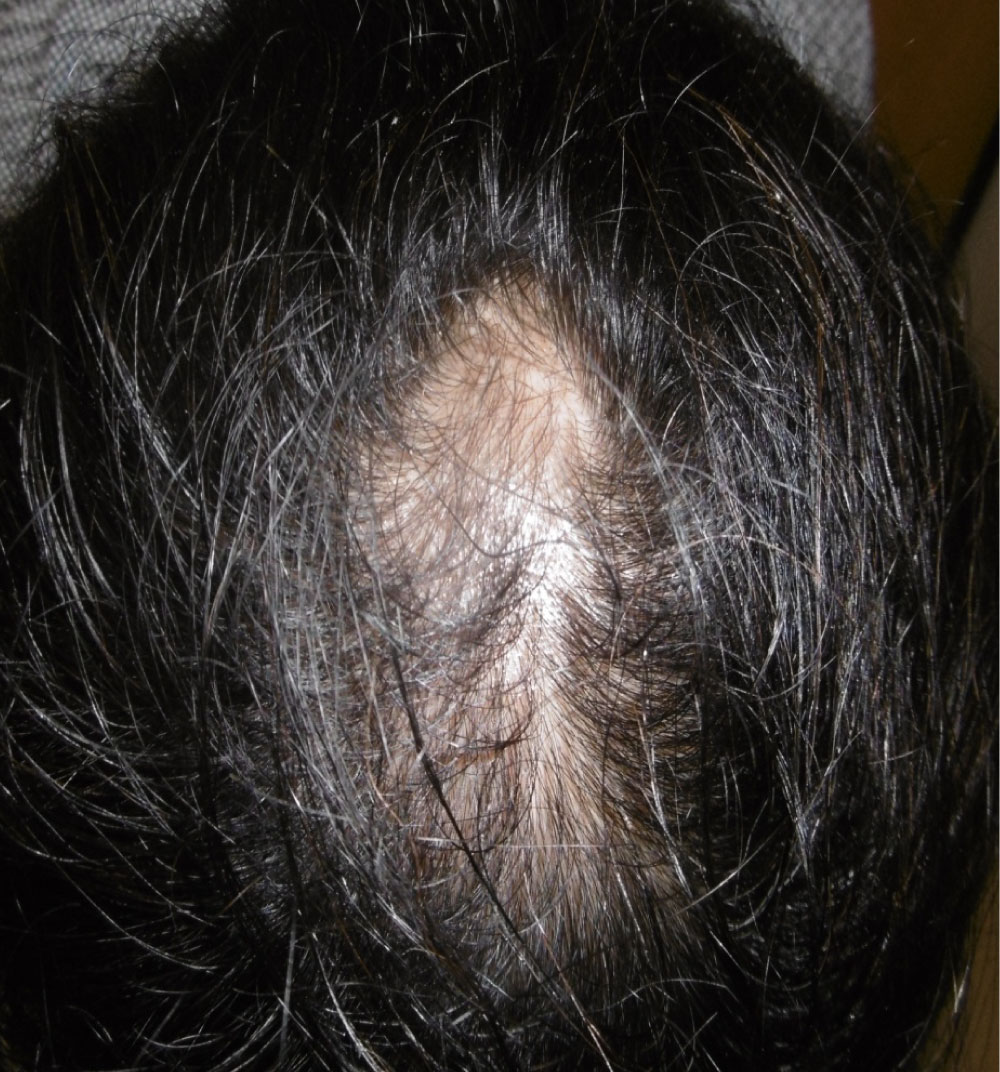 AGA治療 Before