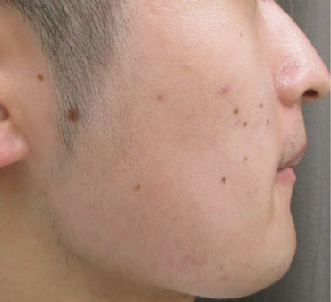 ヒゲ脱毛 Before