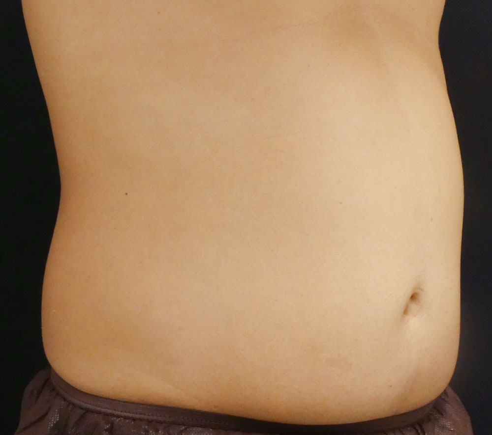 痩身治療 Before